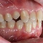 Image result for anquilosis