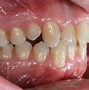 Image result for anquilosis