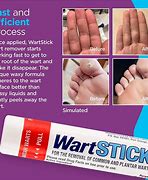 Image result for How to Apply Wart Acid