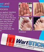 Image result for Warts Removal Treatment