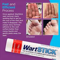 Image result for Wart After Salicylic Acid Treatment