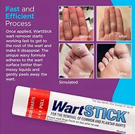 Image result for Wart Removal Stick
