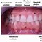 Image result for Maxillary Gingiva