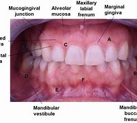 Image result for Gingival Mucosa