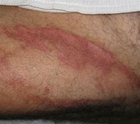 Image result for Manchineel Skin Burn