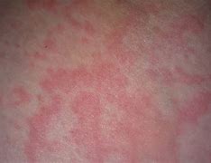 Image result for Skin Rash Under Arms