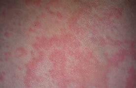 Image result for Raised Itchy Rash On Body