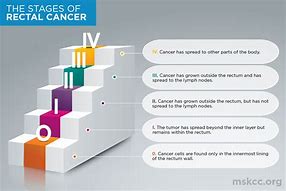 Image result for Bowel Cancer Stages