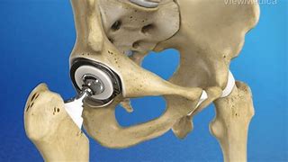 Image result for Hip Pinning Surgery