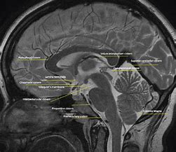 Image result for Brain Anatomy Basal Cisterns