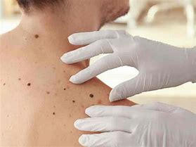 Image result for Dermatology Skin Cancer