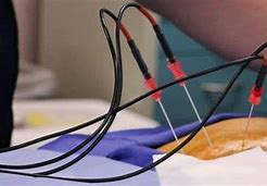 Image result for Ablation Needle