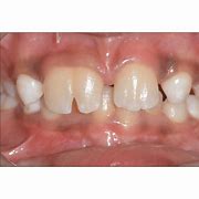 Image result for Upper Right Lateral Incisor