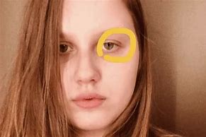 Image result for Madeleine McCann Eye Defect