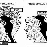 Image result for Anencephalic Pea Brain