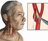 Image result for Carotid Artery Plaque Removal