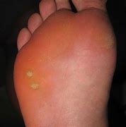 Image result for Pics of Plantar Warts On Feet