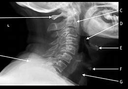 Image result for Cervical Spine X-ray Anatomy