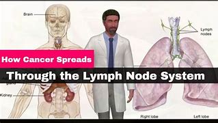 Image result for Stage 4 Cancer Lymph Nodes