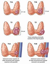 Image result for Cancer Tumor Sizes