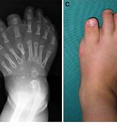 Image result for Feet 8 Toes