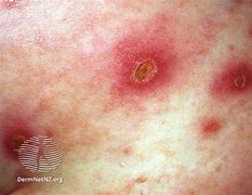 Image result for Acthyma