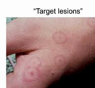 Image result for Target-Shaped Lesion