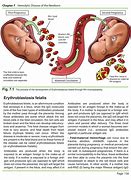 Image result for Erythroblastosis