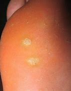 Image result for Are There Different Types of Warts