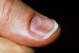 Image result for Two Nails On One Finger