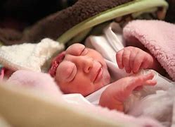 Image result for Baby Theresa Anencephaly