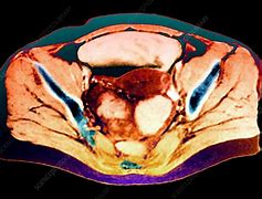 Image result for Twelve Pound of Ovarian Tumor