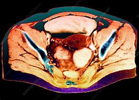 Image result for Ovarian Cancer On MRI