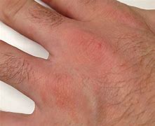 Image result for Scabies On Palm of Hand
