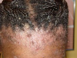 Image result for Dry Skin Eczema On Scalp