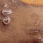 Image result for scabies bed bug signs