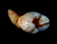 Image result for Prevent Tooth Decay