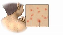 Image result for How Is Chickenpox Transmitted