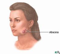 Image result for Jaw Bone Infection Symptoms