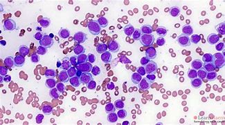 Image result for Acute Leukemia Blood Smear
