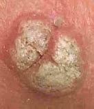 Image result for Venereal Warts