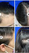 Image result for Hair Loss Teenager