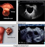 Image result for ovary dermoid cysts cancerous