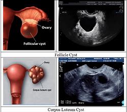 Image result for 8 Cm Cyst On Ovary
