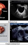 Image result for 2 Cm Ovarian Cyst