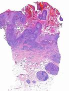 Image result for Verrucous Sarcoid