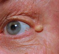 Image result for Epidermoid Cyst On Face