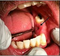 Image result for Infected Jaw Bone Removed