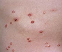 Image result for Molluscum Contagiosum Infection Stages