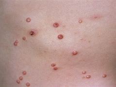 Image result for Molluscum Removal
